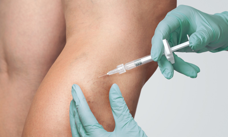 Sclerotherapy effectively treats varicose veins and spider veins. 